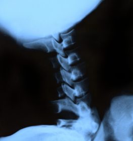 Scan of x-ray of the neck, cervical area